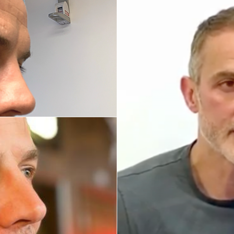 blepharoplasty-surgery-experience