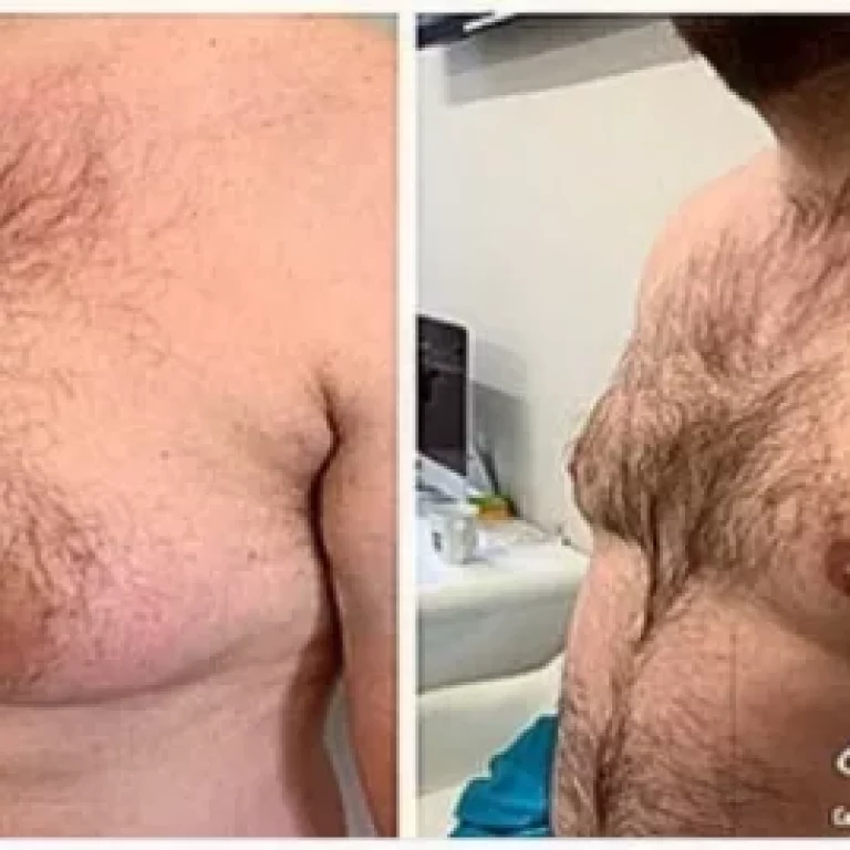 Life-Changing Impact of Gynecomastia Surgery