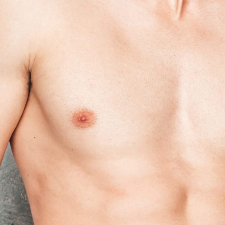 What is Gynecomastia